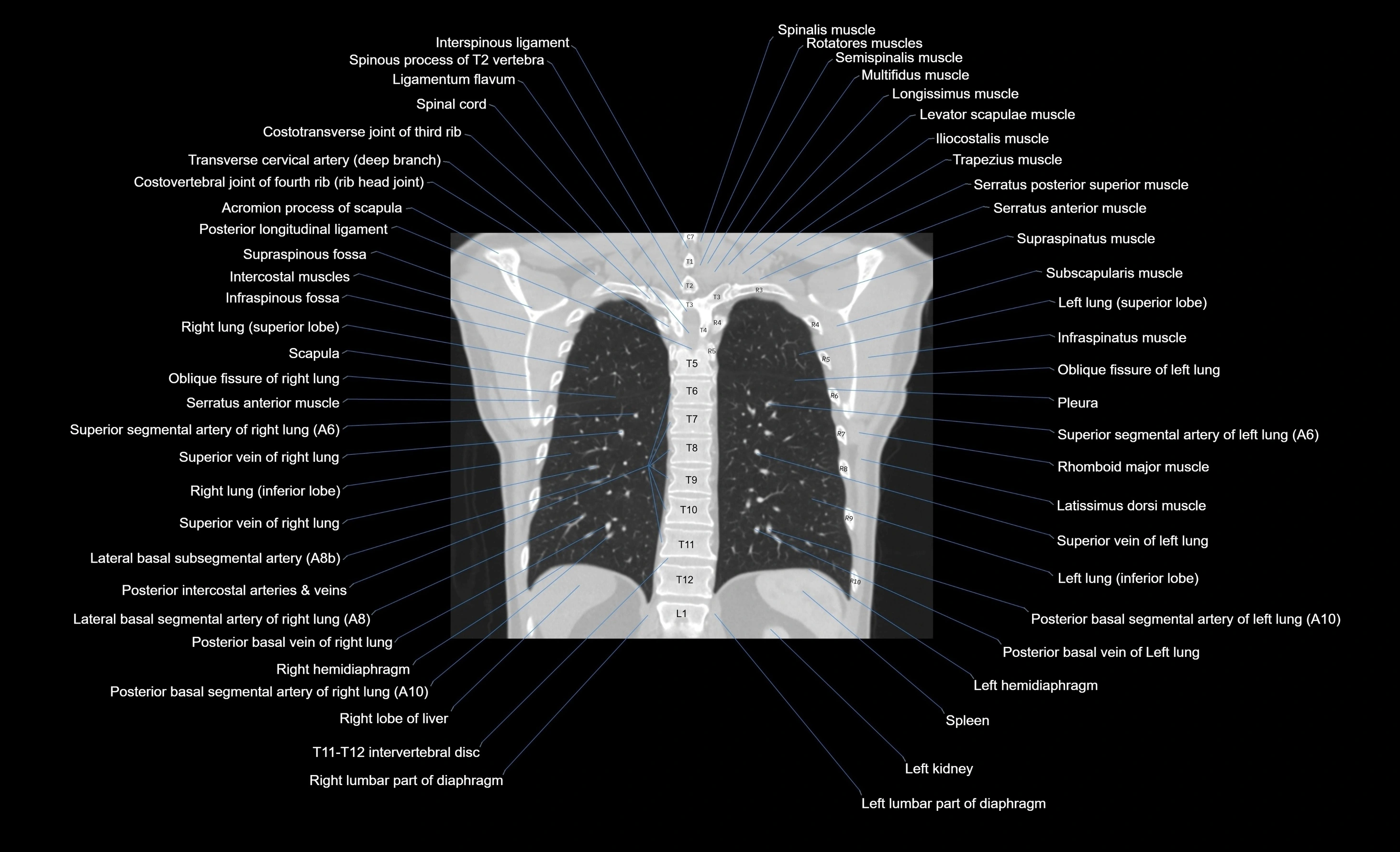 CT chest (thorax) labelled coronal cross sectional anatomy radiology image-00034.webp